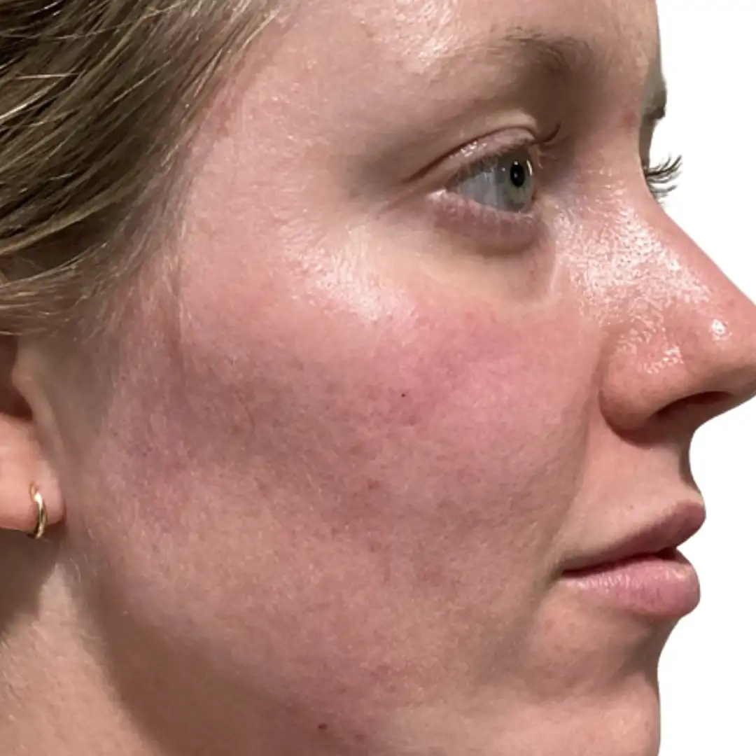 Woman Right Side Closeup Image after skin treatment