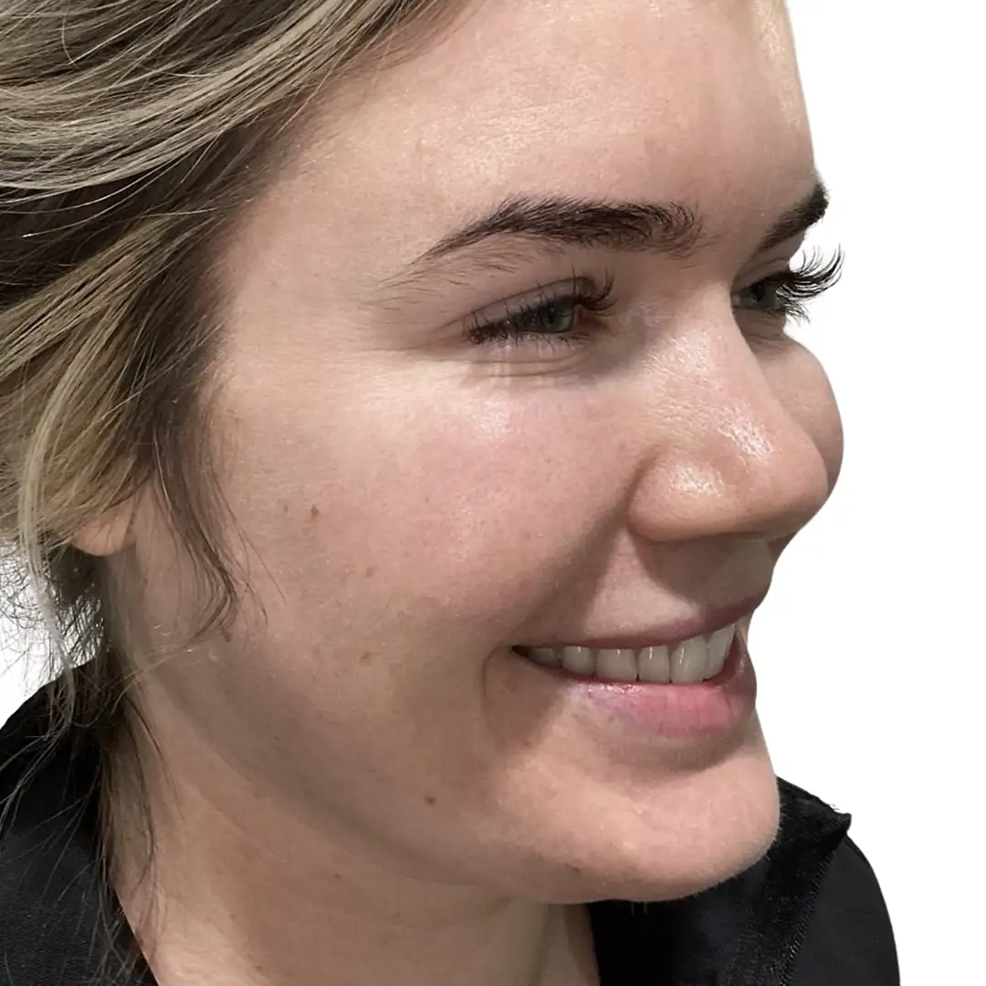 Side-by-side photos of a lady in Chesapeake, VA, showing the lower face before and after dermal filler treatment