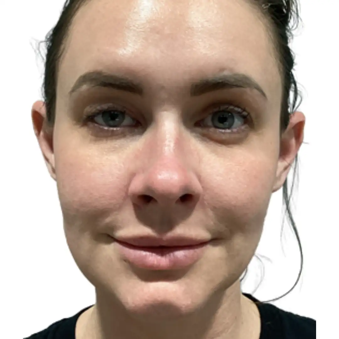 Front Closeup image of a girl with enhanced facial feature after aesthetic procedure in Chesapeake, VA