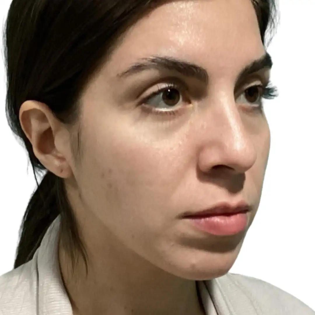 Side‑by‑side before‑and‑after images of a patient treated in Chesapeake, VA, showing enhanced lip volume