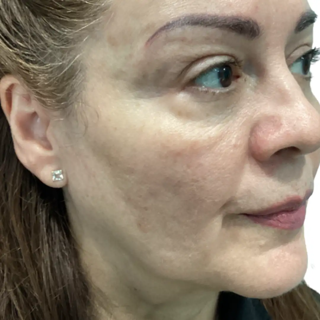 Right Closeup Photo of a Girl after facial treatment in Chesapeake, VA at Eluxir MD