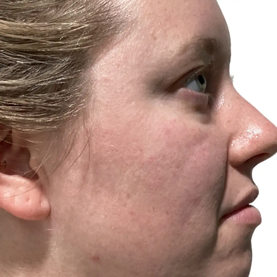 Side‑by‑side before-and-after comparison showing a patient’s midface and under-eye area following dermal filler treatment in Chesapeake, VA