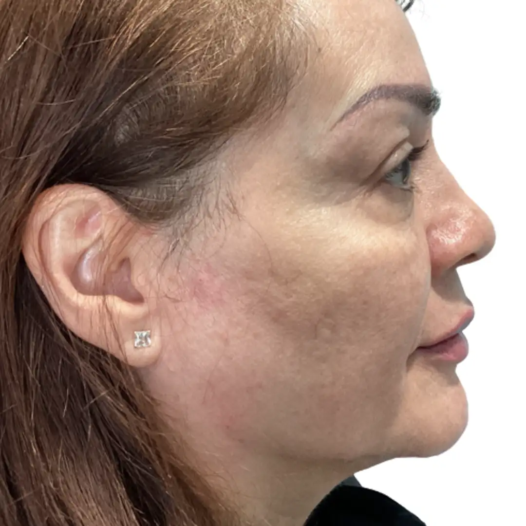 Right Side Closeup Image of a Woman after Facial aesthetics Treatment in Chesapeake, VA at Eluxir MD