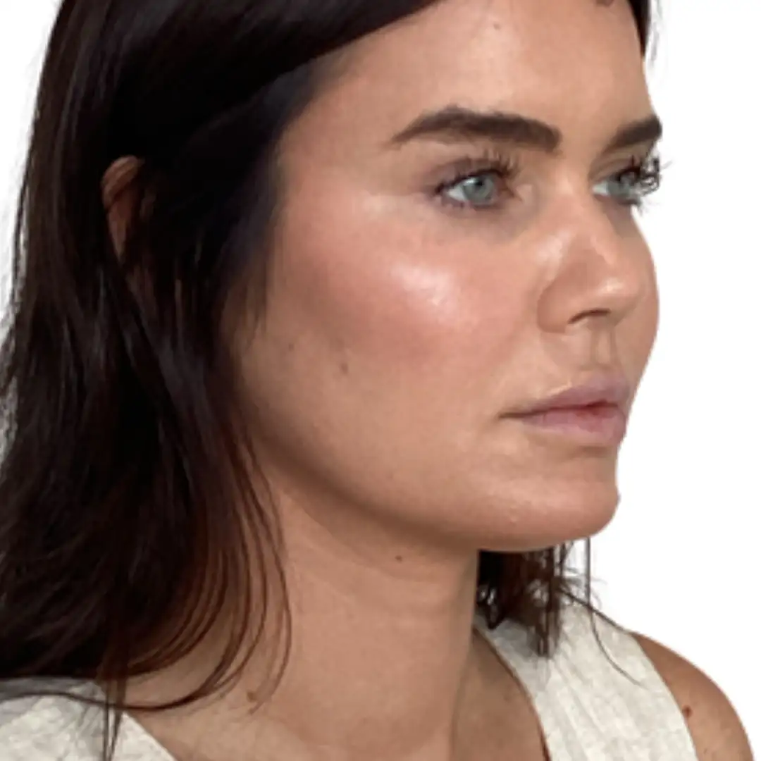 Lady Right Side Closeup photo after aesthetic treatment in Chesapeake, VA at Eluxir MD