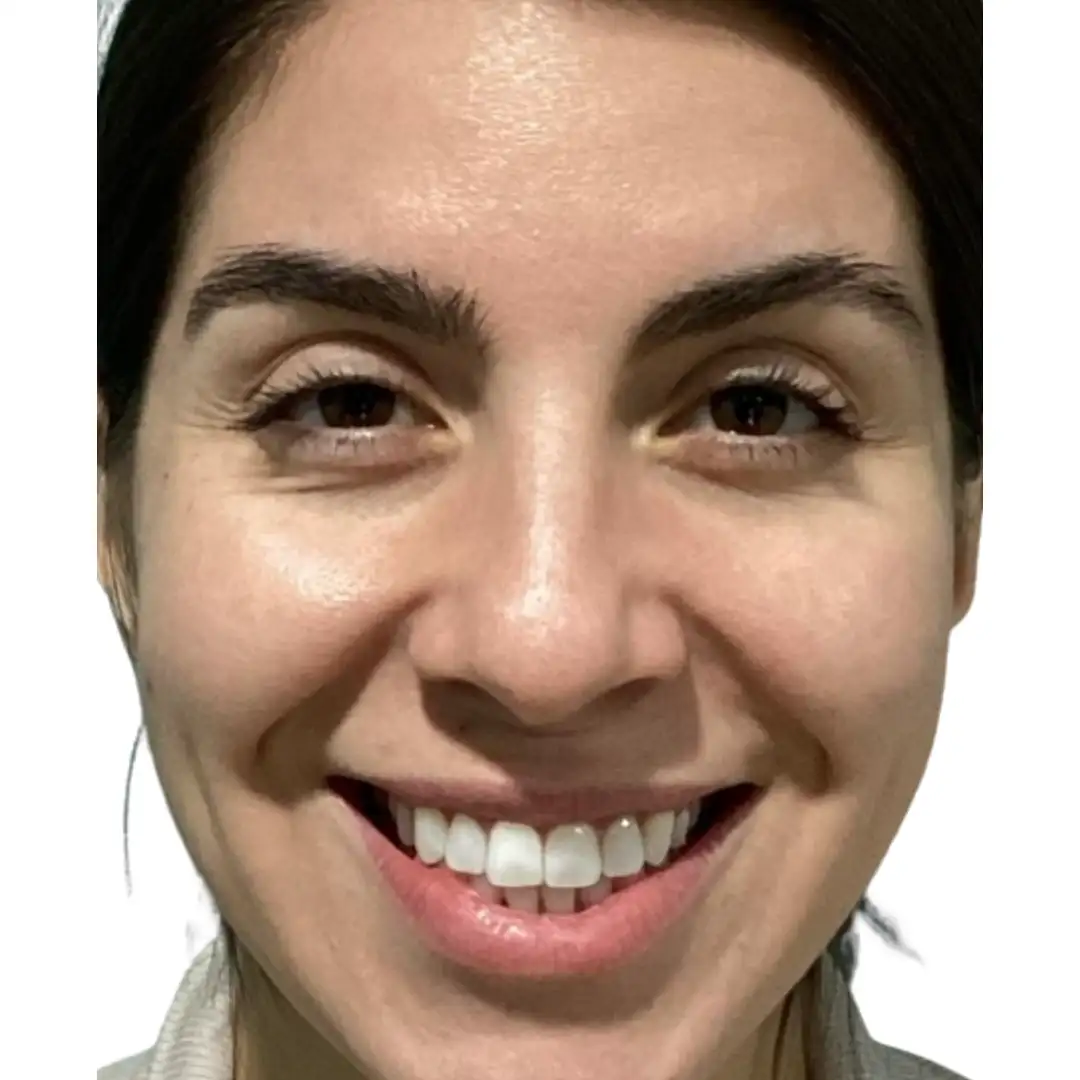 Lady closeup photo after skin treatment in Chesapeake, PA at Eluxir MD