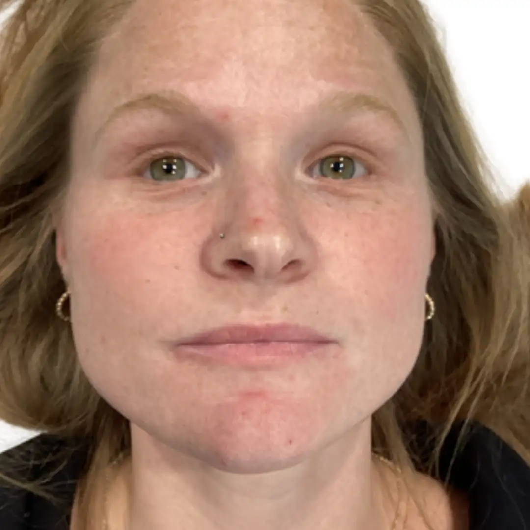 Before and after image from Eluxir MD in Chesapeake, VA, showing visible reduction in wrinkles