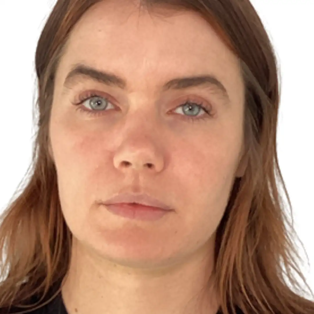 Woman Closeup Photo with facial improvement after facial treaatment at Eluxir MD in Chesapeake, VA