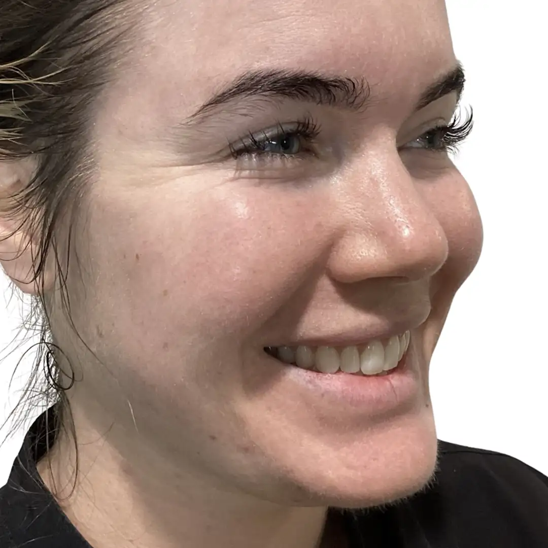 Before-and-after photos of a patient in Chesapeake, VA, highlighting subtle dermal filler enhancements