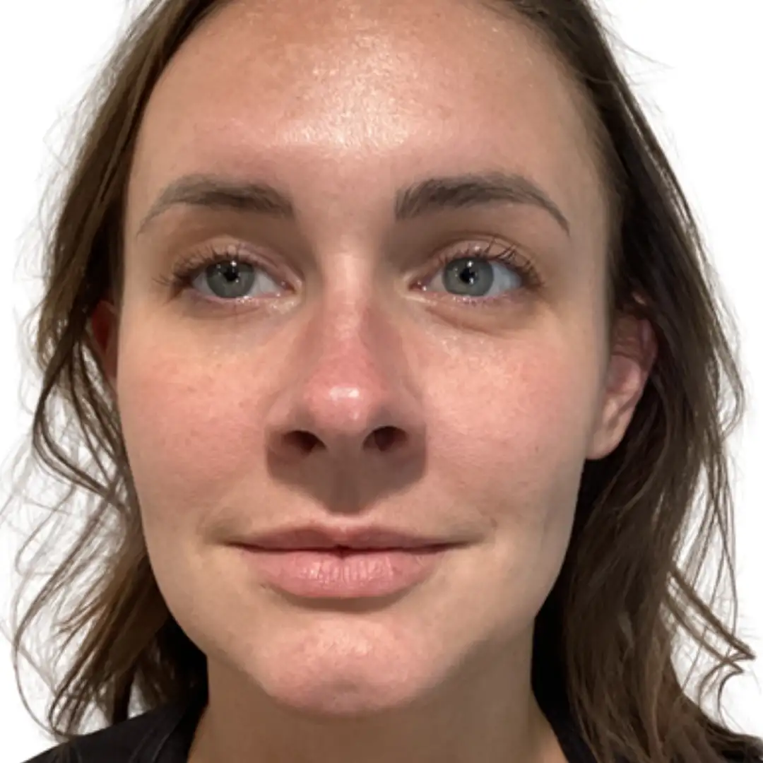 Before and after treatment photo of a girl in Chesapeake, VA at Eluxir MD