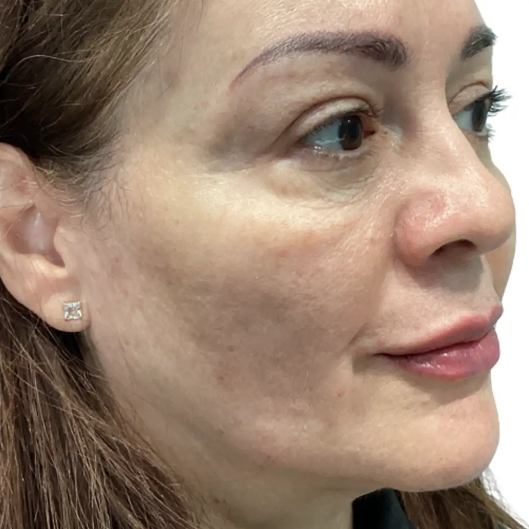 Closeup Image of a Mid Aged Woman after aesthetic treatment at Eluxir MD in Chesapeake, VA
