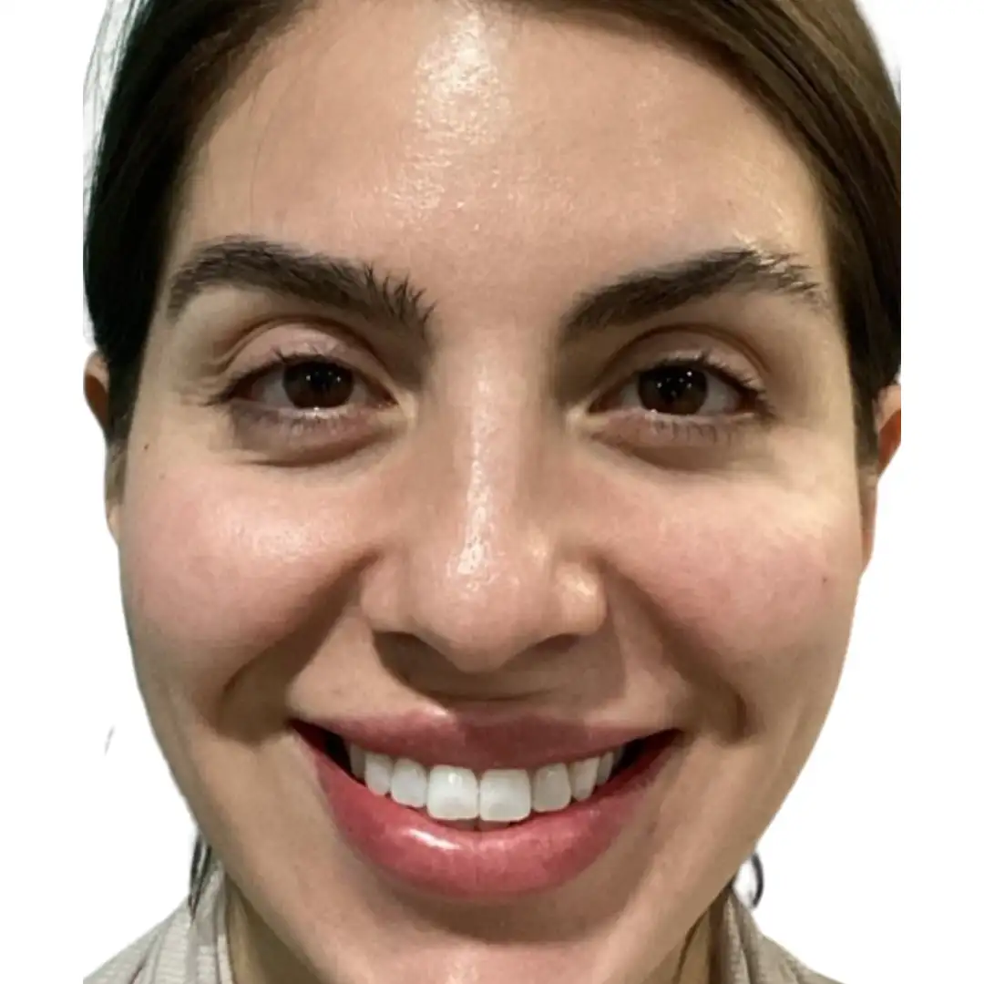Facial Treatment Before and After Closeup Image of a Woman at Eluxir MD in Chesapeake, VA