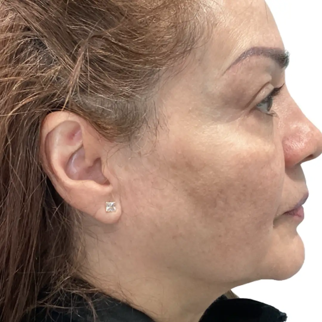 Woman Closeup Image after facial treatment at Eluxir MD in Chesapeake, VA