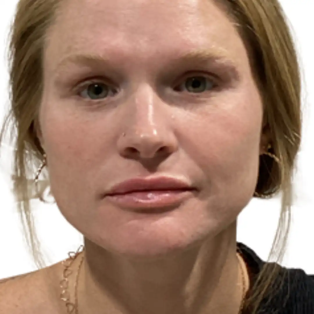 Image of a Girl before facial treatment at Eluxir MD in Chesapeake, VA