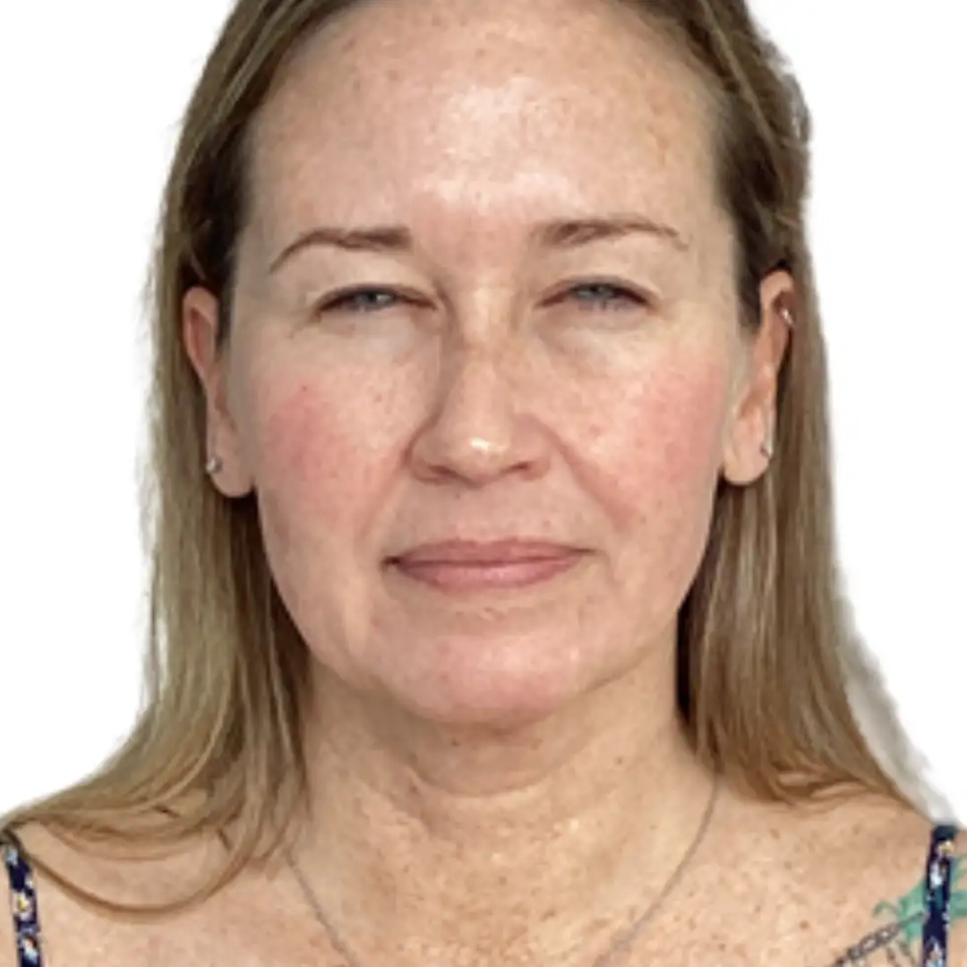 Before and after photo from Eluxir MD in Chesapeake, VA, seeking for facial tightening treatment