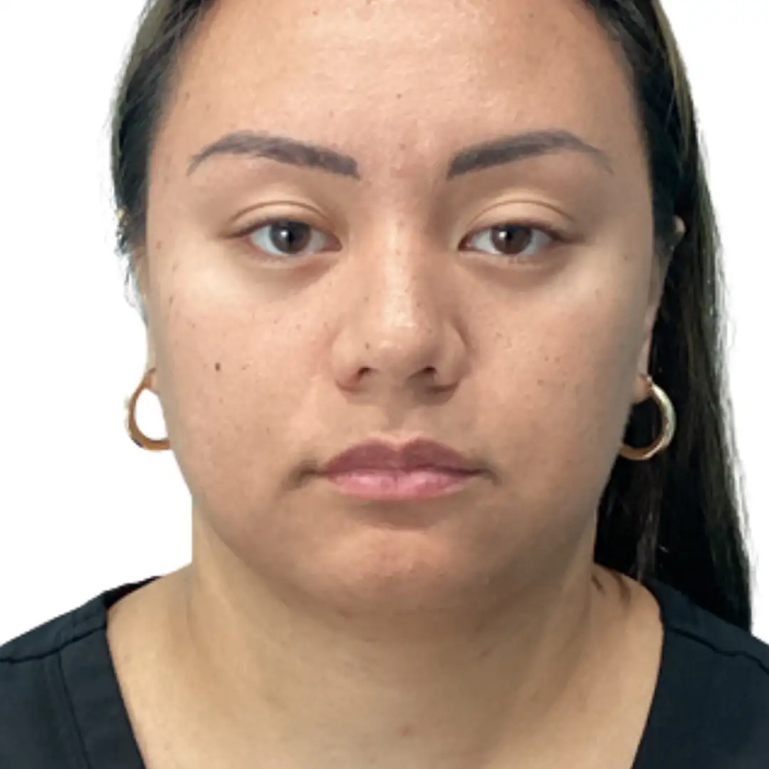 Before and after image from Eluxir MD in Chesapeake, VA, showing visible facial rejuvenation