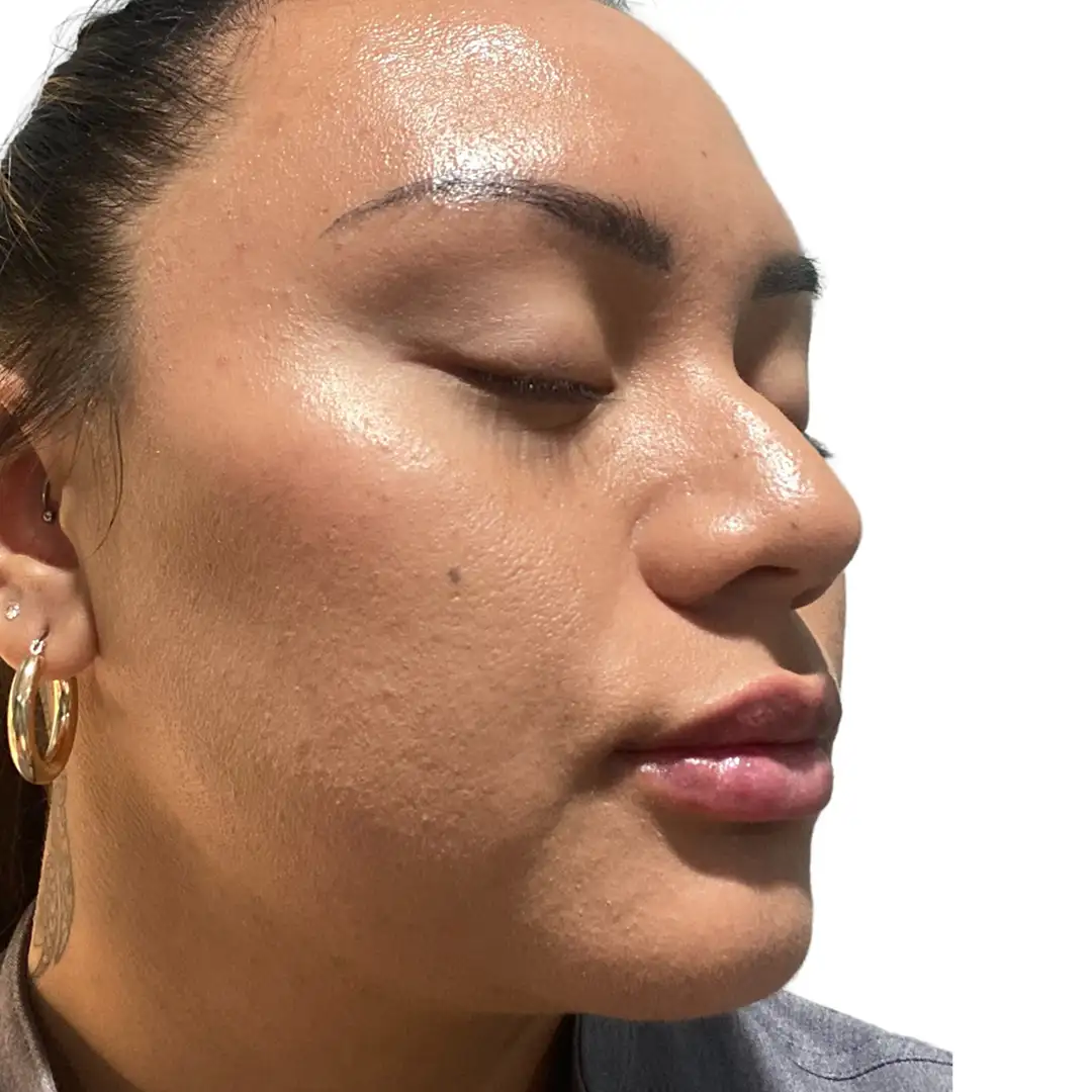 Before and after photo from EluxirMD in Chesapeake, VA, highlighting smoother skin and diminished wrinkles after non-invasive facial treatment