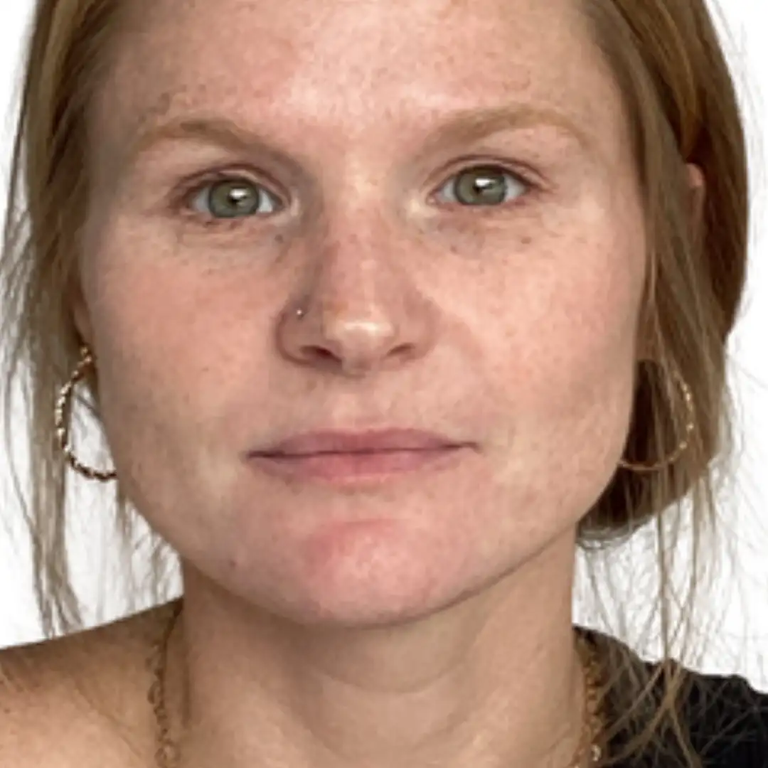 Before and after treatment photo of a Girl in Chesapeake, VA at Eluxir MD