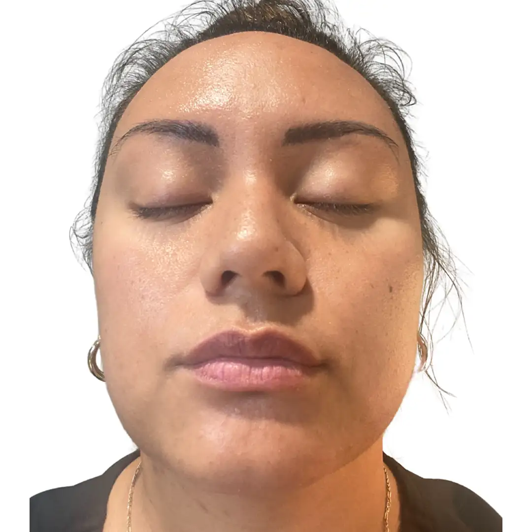 Facial Closeup look of a girl after skin aesthetic treatment in chesapeake, va at Eluxir MD