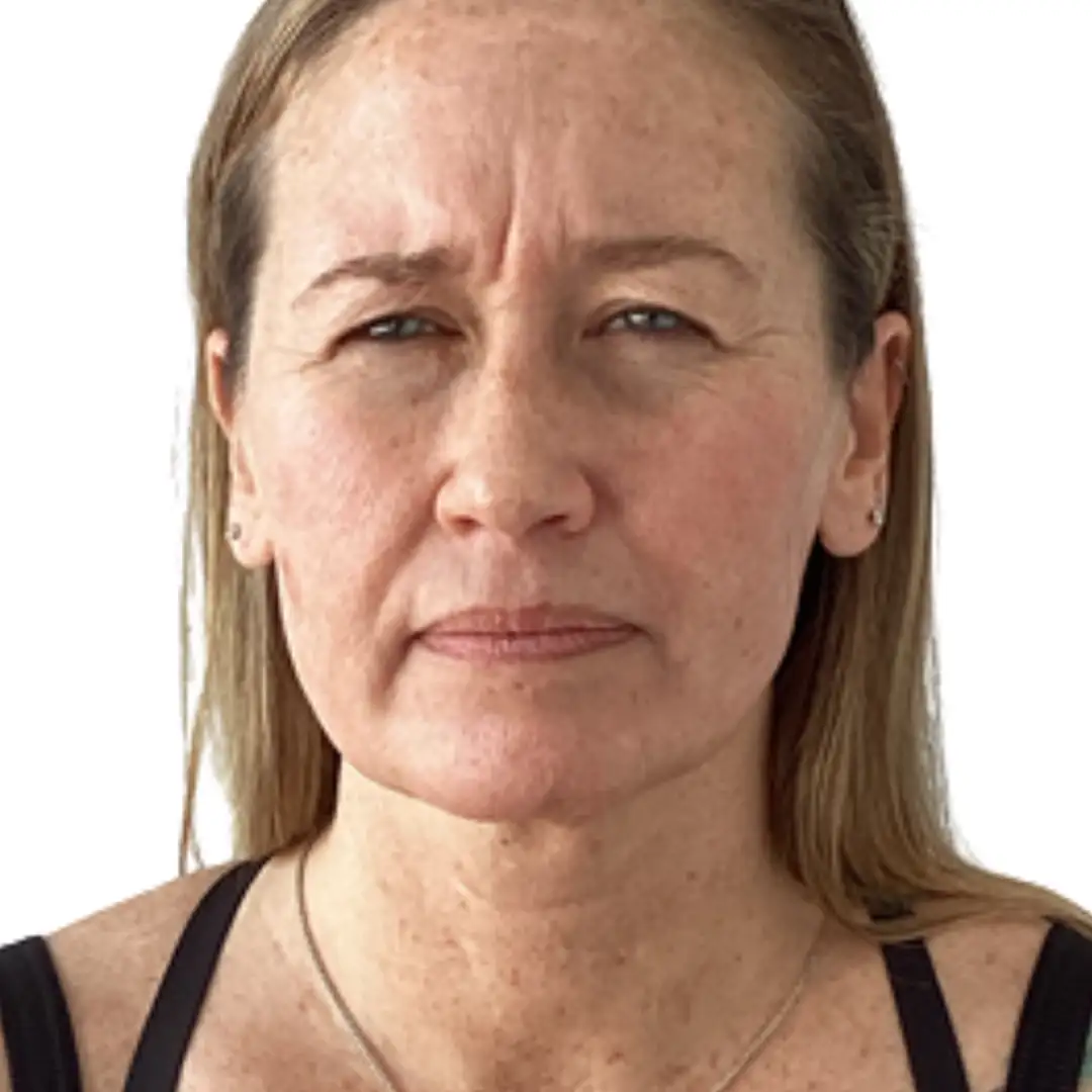 Before and after results at EluxirMD in Chesapeake, VA, showing improved skin texture and reduced fine lines following cosmetic skin treatment