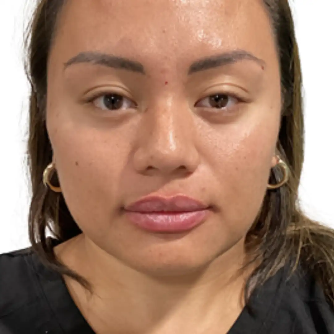 Lady image before aesthetic treatment at Eluxir MD in Chesapeake, VA