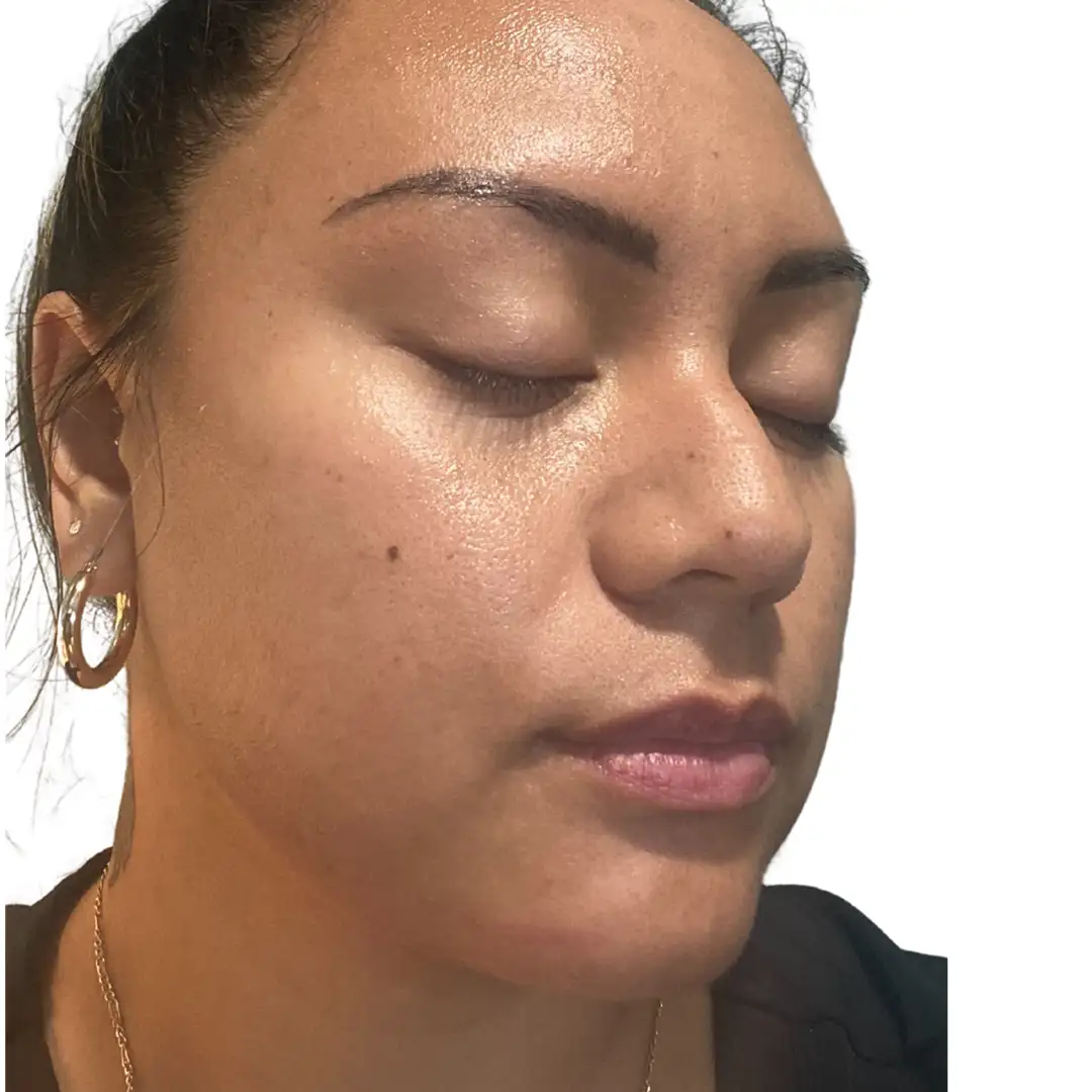 Closeup image of a girl with closed eyes before aesthetic treatment at Eluxir MD in Chesapeake, VA