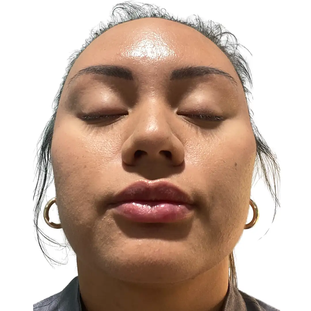 Closeup Image of a girl before facial treatment at Eluxir MD in Chesapeake, VA