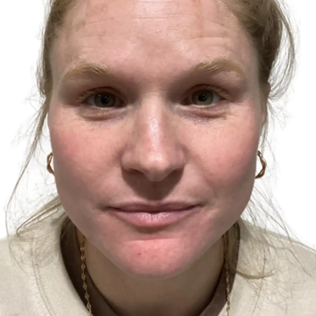 Before and after photo from Eluxir MD in Chesapeake, VA, highlighting smoother, firmer ski