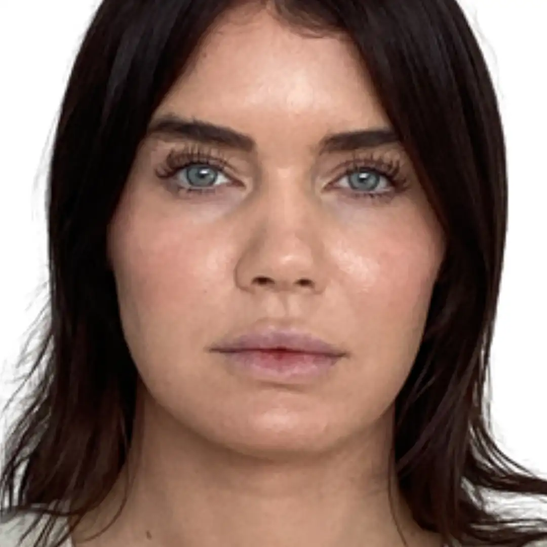 Girl Closeup Image after Skin Condition Treatment at Eluxir MD in Chesapeake, VA