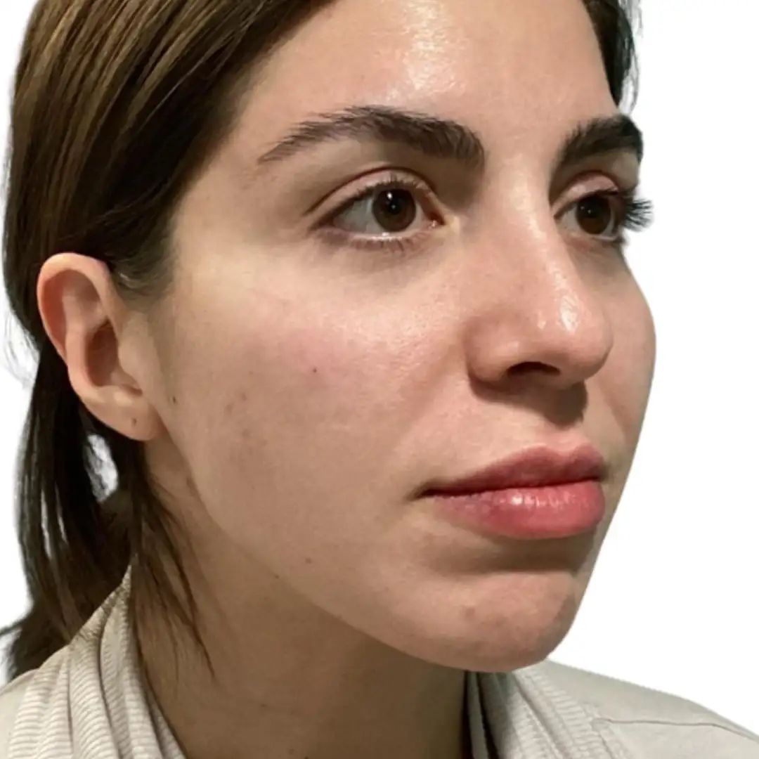 Girl Closeup Image after Aesthetic Treatment in Chesapeake, VA at Eluxir MD