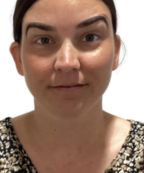 Before and after image showing significant aesthetic improvement from a treatment at EluxirMD in Chesapeake, VA