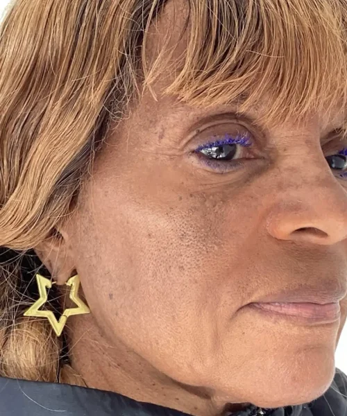 Sixth Before and after Treatment Image of a Women at Eluxir MD in Chesapeake, VA