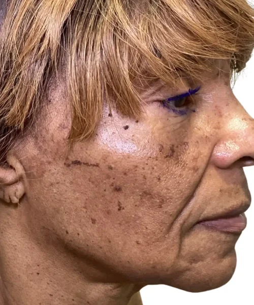 Ninth Before and after Treatment Image of a Women at Eluxir MD in Chesapeake, VA