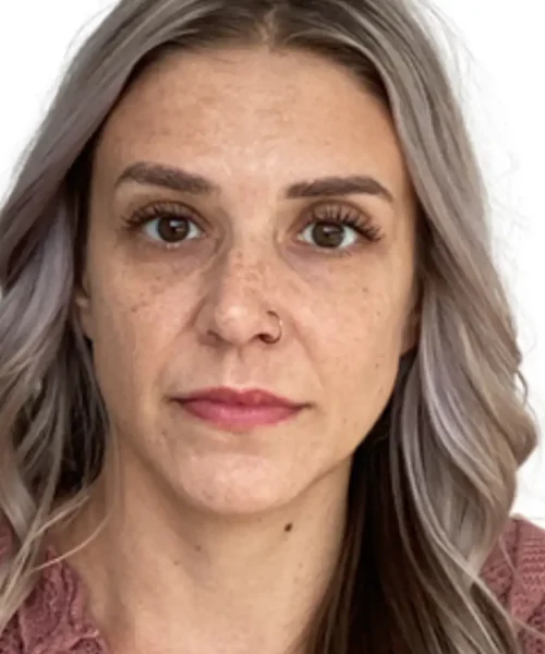 Tenth Before and after Treatment Image of a Women at Eluxir MD in Chesapeake, VA