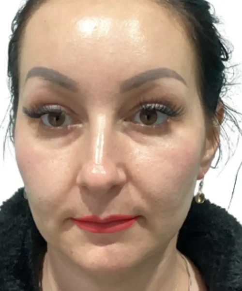 Fifth Before and after Treatment Image of a Women at Eluxir MD in Chesapeake, VA