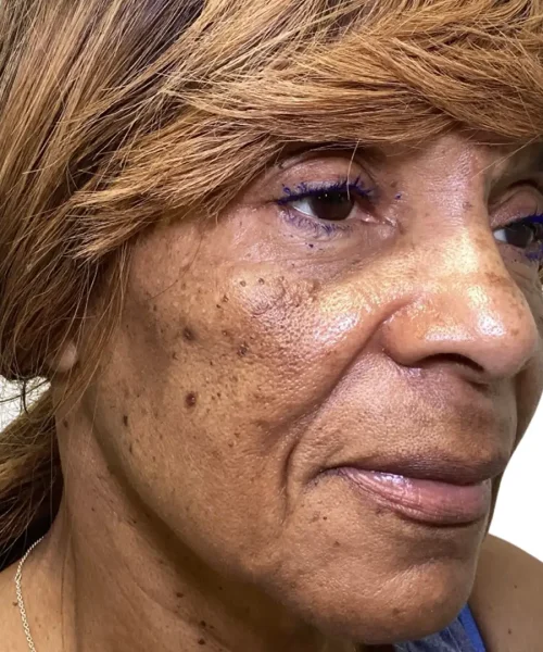 Seventh Before and after Treatment Image of a Women at Eluxir MD in Chesapeake, VA