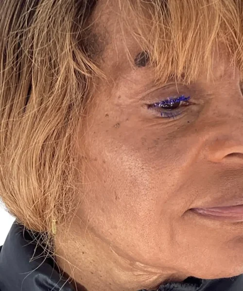 Eighth Before and after Treatment Image of a Women at Eluxir MD in Chesapeake, VA