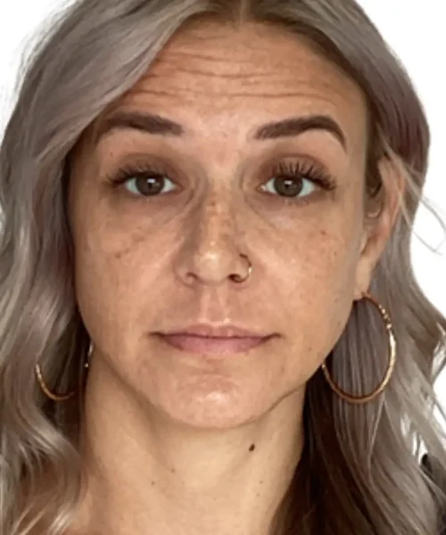 Eleventh Before and after Treatment Image of a Women at Eluxir MD in Chesapeake, VA