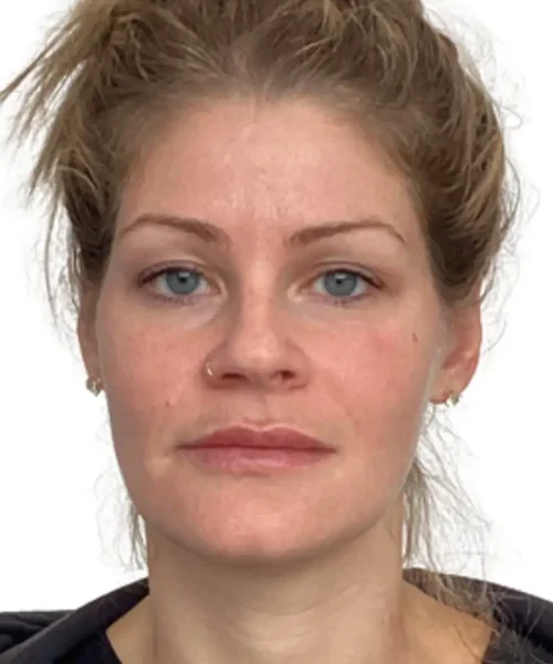 Lady with facial features seeking for facial treatment at Eluxir MD in Chesapeake, VA