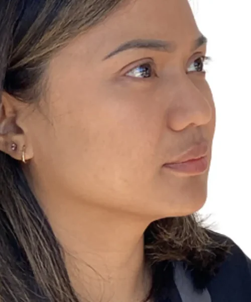 Before and after photo from Eluxir MD in Chesapeake, VA, showing clearer, more even-toned skin following advanced facial treatment