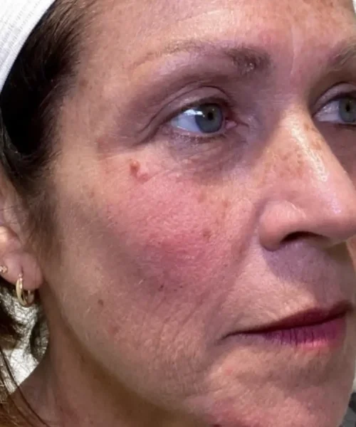 Treatment Before Image in Chesapeake, VA, highlighting wrinkles seeking for facial rejuvenation treatment