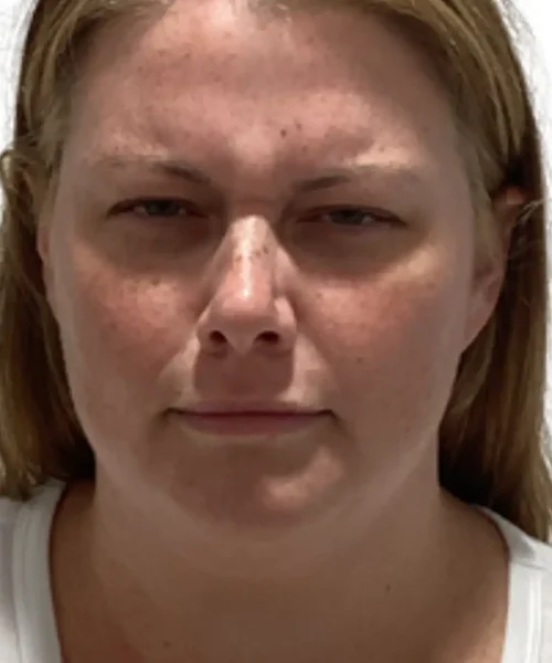 Lady with facial acne spots before treatment seeking for facial rejuvenation at Eluxir MD