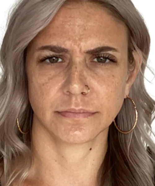 Before and after comparison at EluxirMD in Chesapeake, VA, displaying improved skin texture