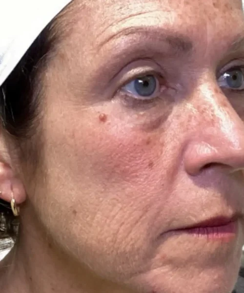Before in Chesapeake, VA, highlighting wrinkles seeking for facial rejuvenation treatment