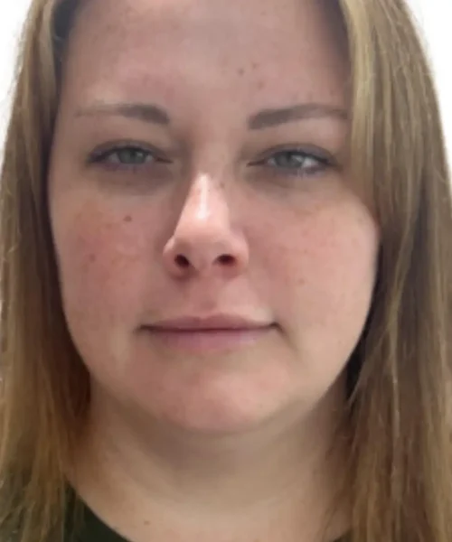 Girl with facial spots seeking for facial treatment at Eluxir MD in Chesapeake, VA