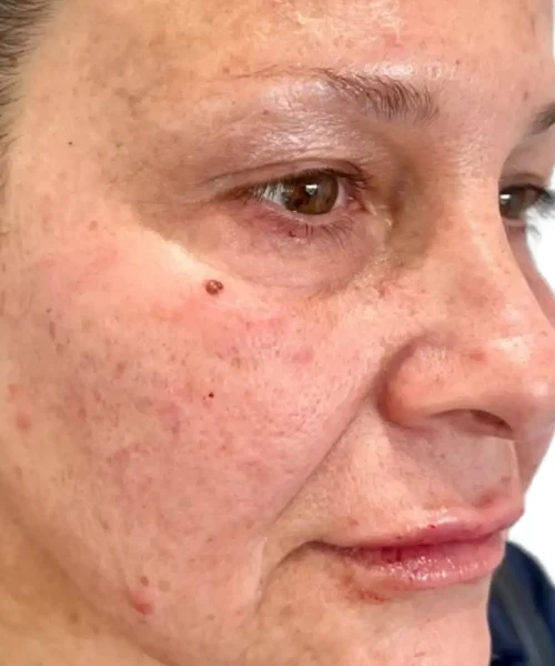 Before and After Treatment Image | Eluxir MD in Chesapeake, VA