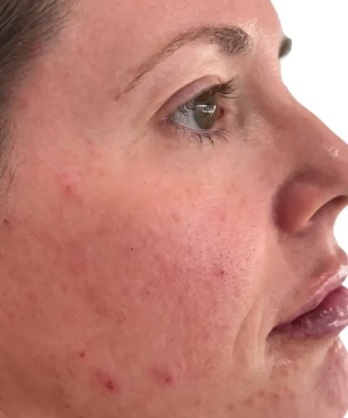 Before Treatment Image of a Girl at Eluxir MD in Chesapeake, VA