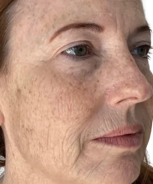 Treatment Before and after at Eluxir MD in Chesapeake, VA