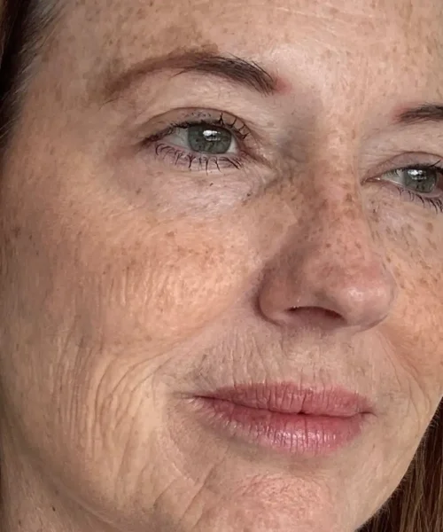 Before and after Treatment Image of a Mid aged Women at Eluxir MD in Chesapeake, VA