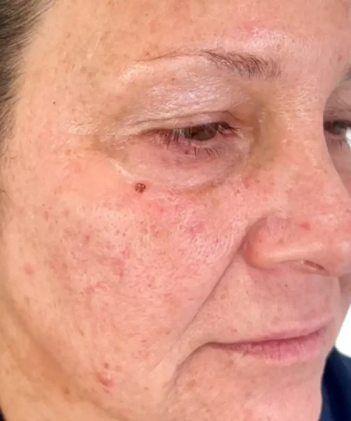 Before After Treatment Image of a Lady at Eluxir MD in Chesapeake, VA