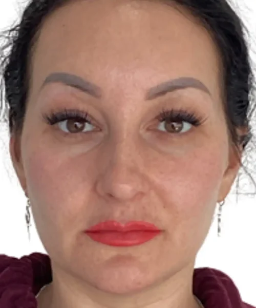 Fourth Before and after Treatment Image of a Women at Eluxir MD in Chesapeake, VA